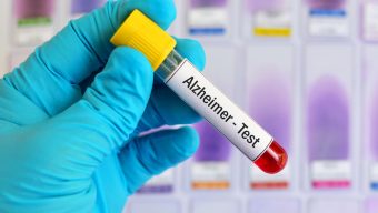 İngiltere’de yeni kan testleriyle Alzheimer ve demans erken teşhis edilebilir mi?